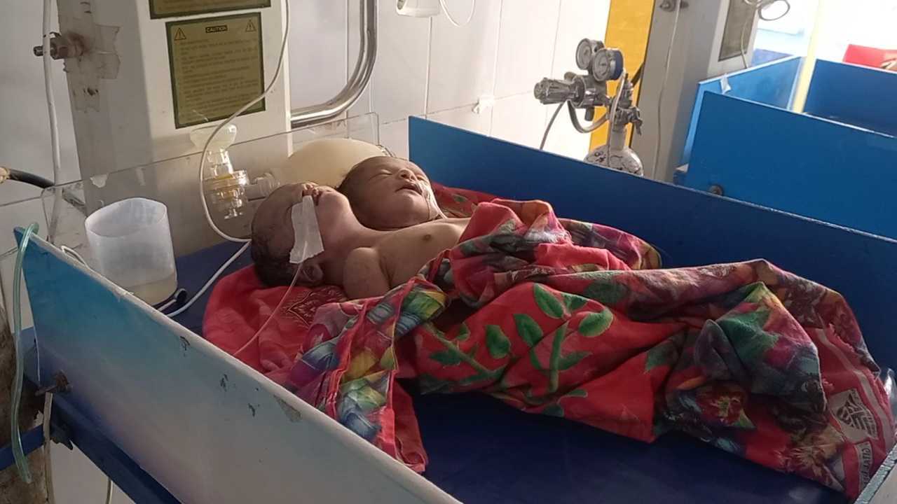পঞ্চগড়ে জন্মগত ত্রুটির সাথে দুই মাথা নিয়ে নবজাতকের জন্ম