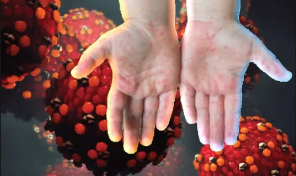 দেশে হামের প্রকোপ বাড়ছে- ২৪ ঘণ্টায় আরও ৫ জনের মৃত্যু